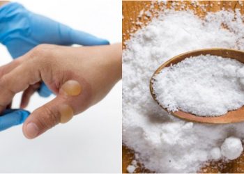Garam Dapur Ternyata Ampuh Obati Luka Bakar Atau Kena Benda Panas!