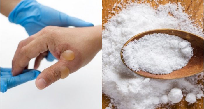 Garam Dapur Ternyata Ampuh Obati Luka Bakar Atau Kena Benda Panas!